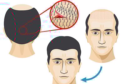 Przeszczep włosów FUT: efekty i czas regeneracji