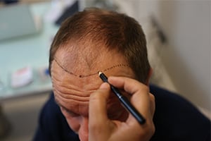 Greffe cheveux Turquie