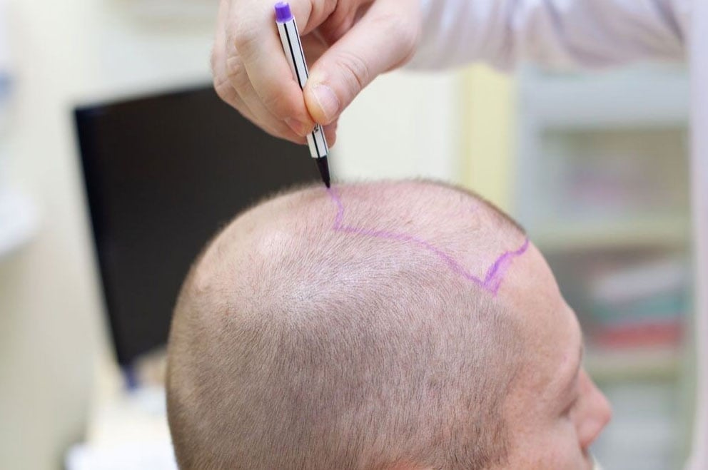 Пересадка волос в Турции и Великобритании: в чем разница?