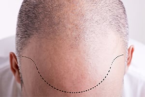 Meilleur clinique greffe de cheveux turquie forum