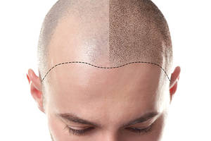 ¿Qué es la mesoterapia capilar, y qué resultados consigue?