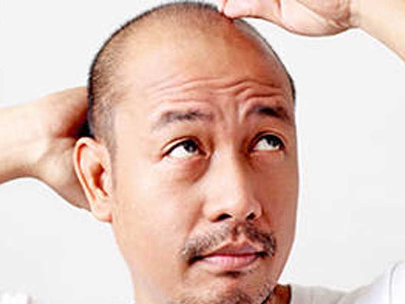 Minoxidil: resultados y efectos secundarios