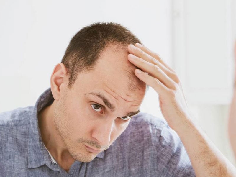 Cheveux prothétiques ou greffe de cheveux : lequel d'entre eux serait la meilleure solution?