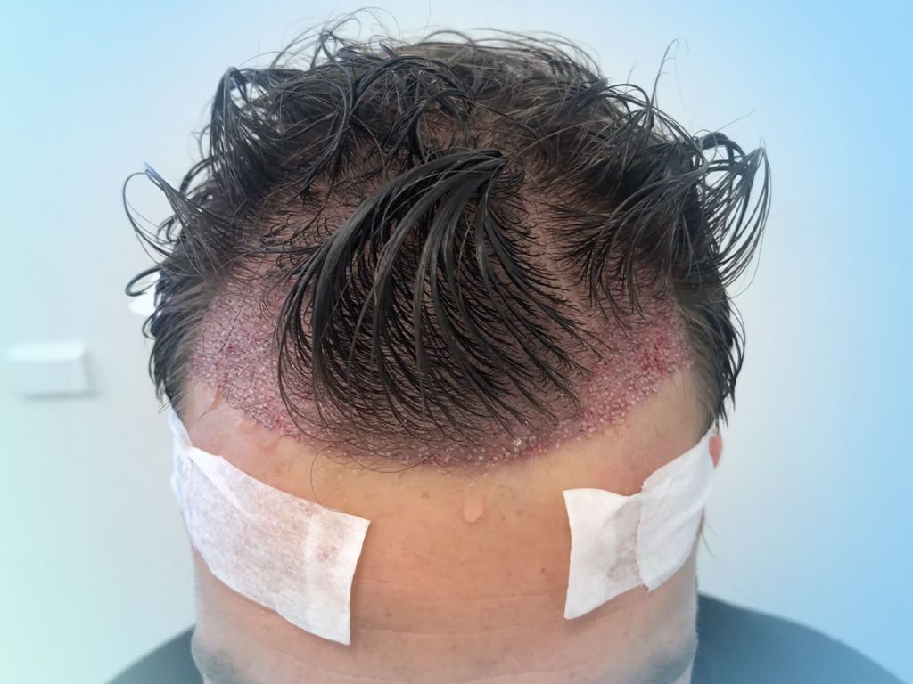 Diagram showing how Unshaven FUE works by trimming small strips hidden by long hair for discreet restoration