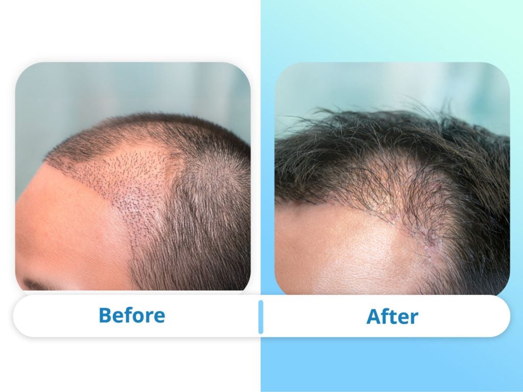 Before and after result of a male patient 12 months after Unshaven FUE hair transplant at Clinicana Istanbul