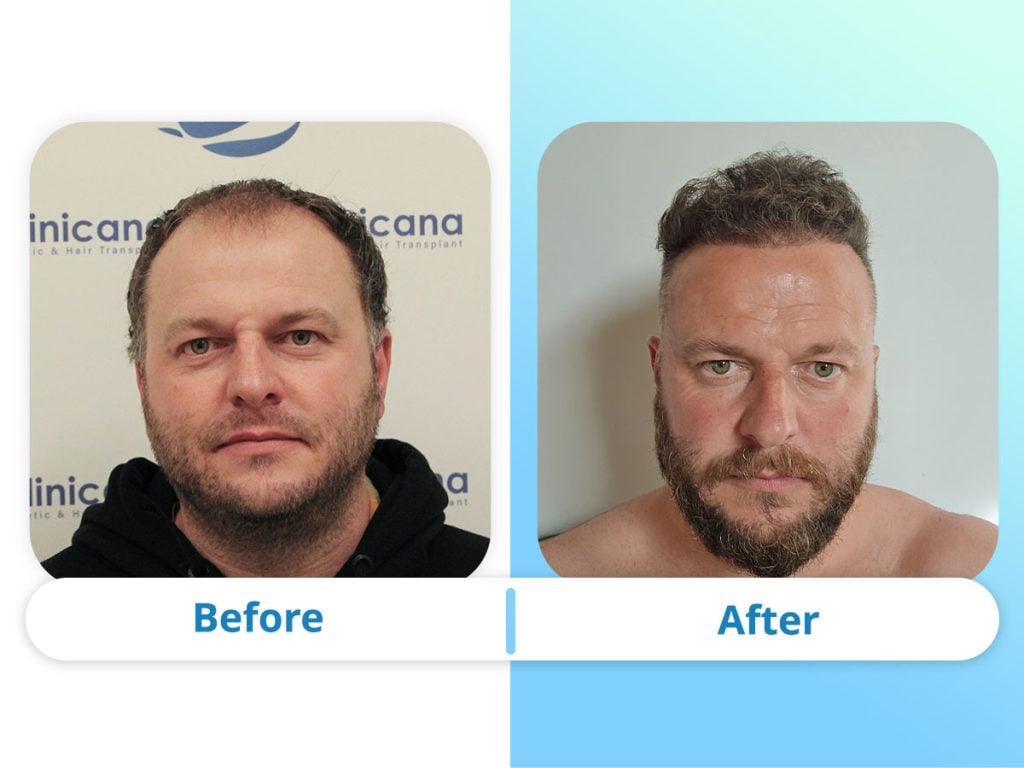 Before and after 3000 graft FUE hair transplant result from Istanbul clinic