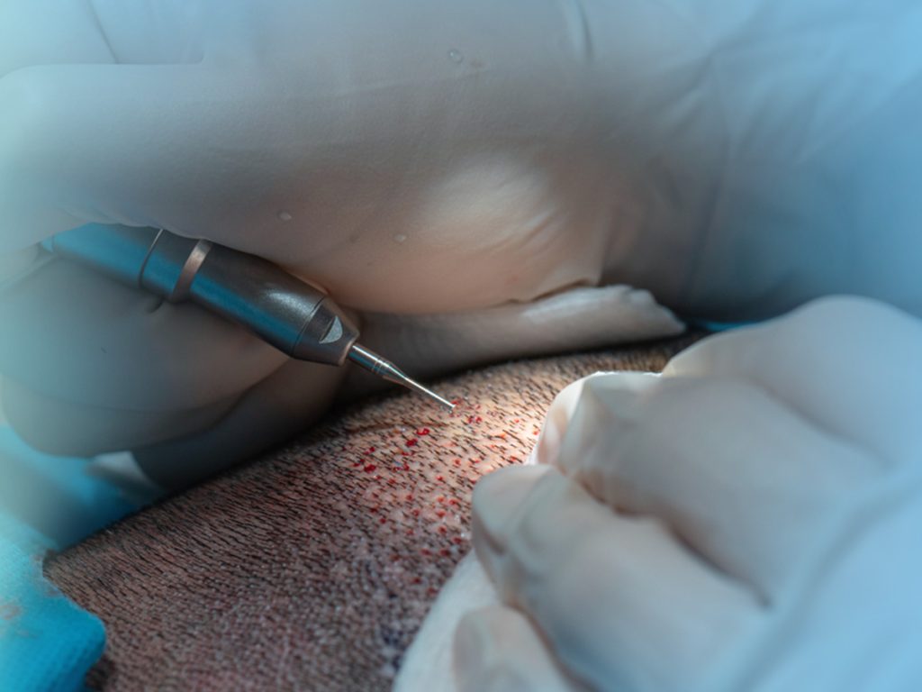 Ce qu’il faut éviter après une greffe de cheveux pour protéger les greffons