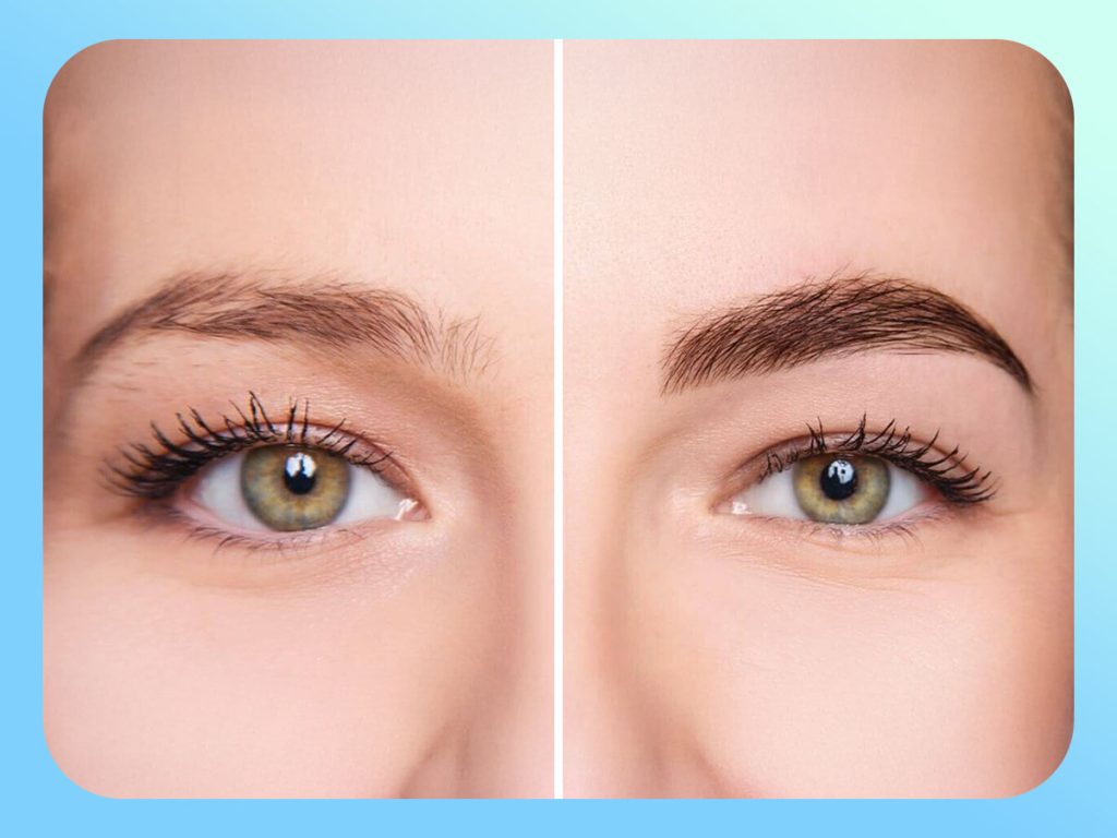 Before and after eyebrow transplant results in a woman with natural brow shape
