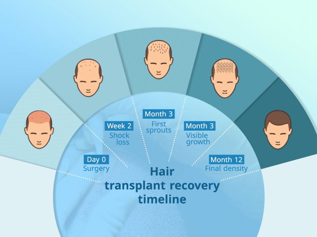 Timeline of hair transplant results showing shock loss at 1 month, early growth at 4 months, and full density at 12 months.