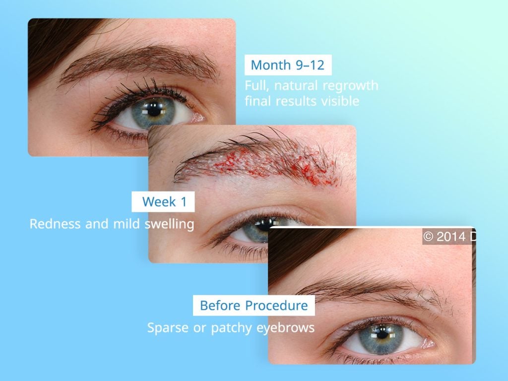 Eyebrow transplant recovery timeline showing healing stages from week 1 to final results after 12 months