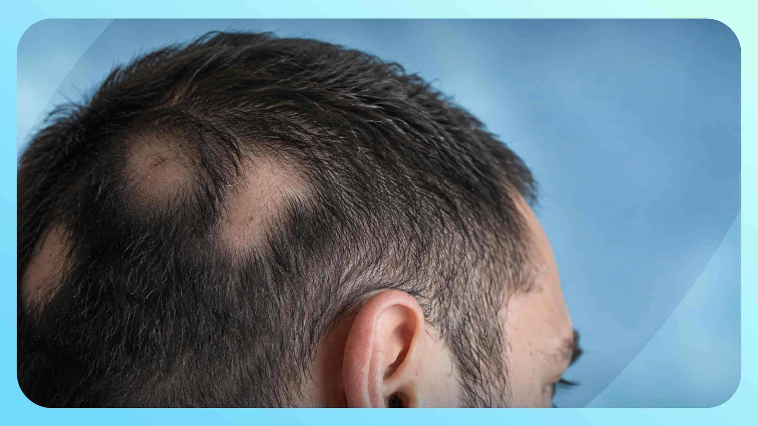 Tinea Capitis (Scalp Ringworm): Causes, Clinical Patterns, and Medical Management