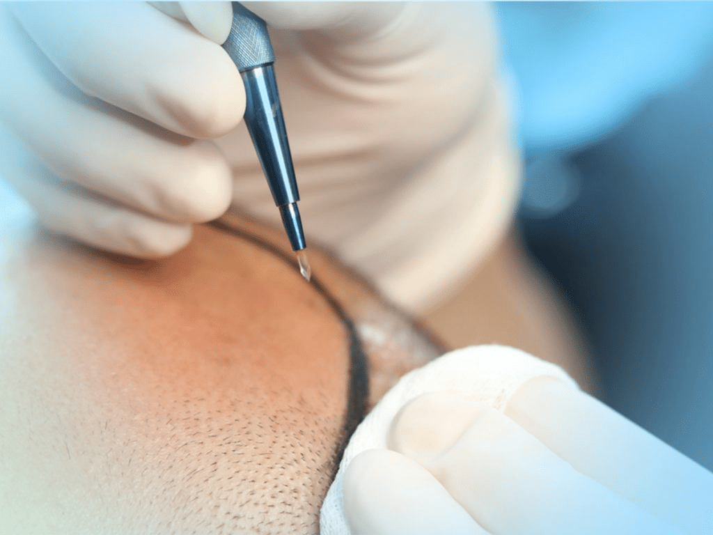صورة لنتائج زراعة الشعر بتقنية السفير تُظهر خط شعر طبيعي قبل وبعد العملية