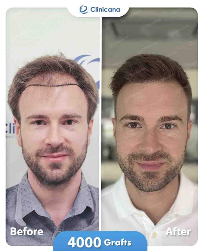 Natural hairline design achieved with DHI hair transplant method