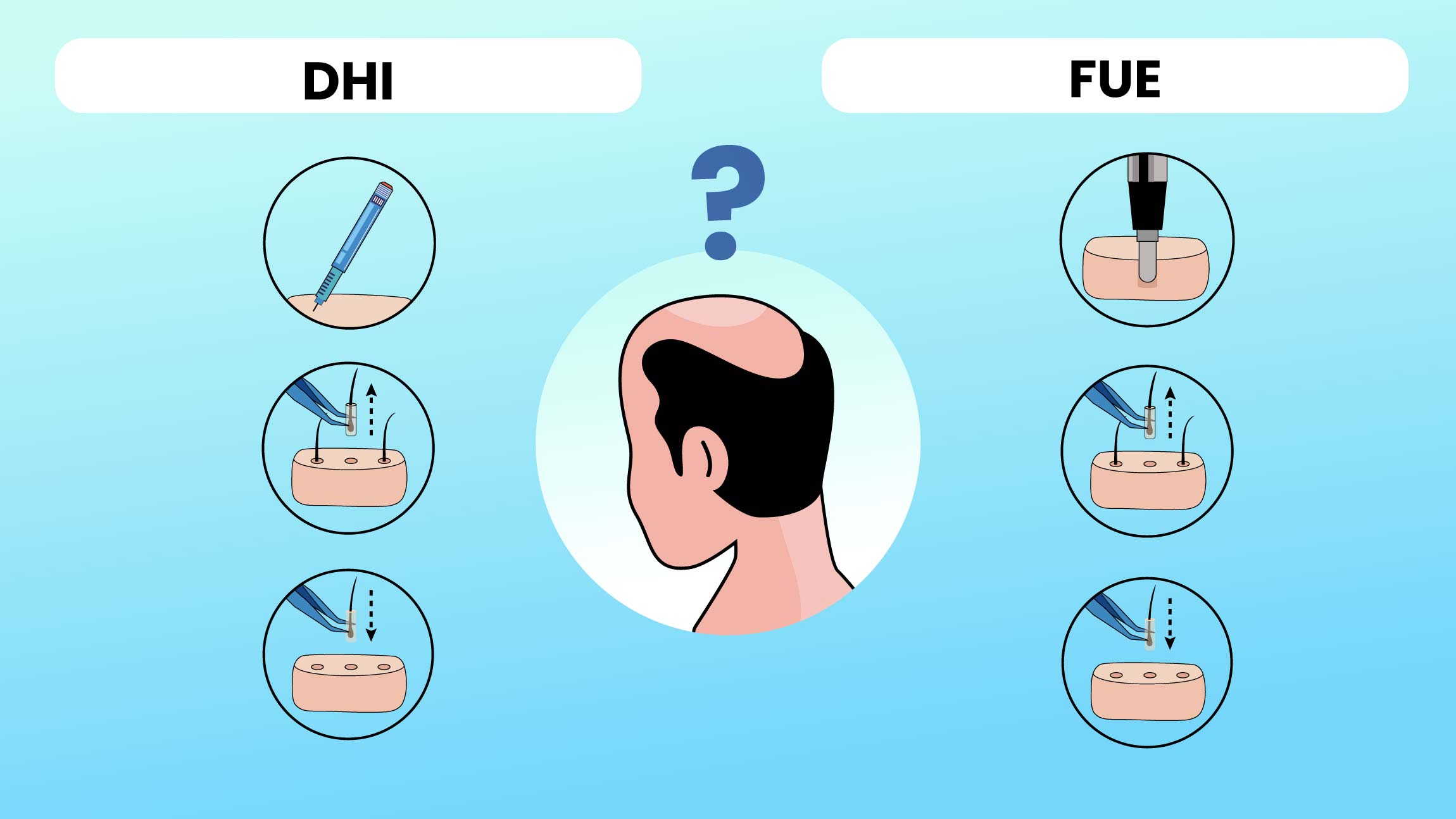 najtańszy przeszczep włosów w Turcji