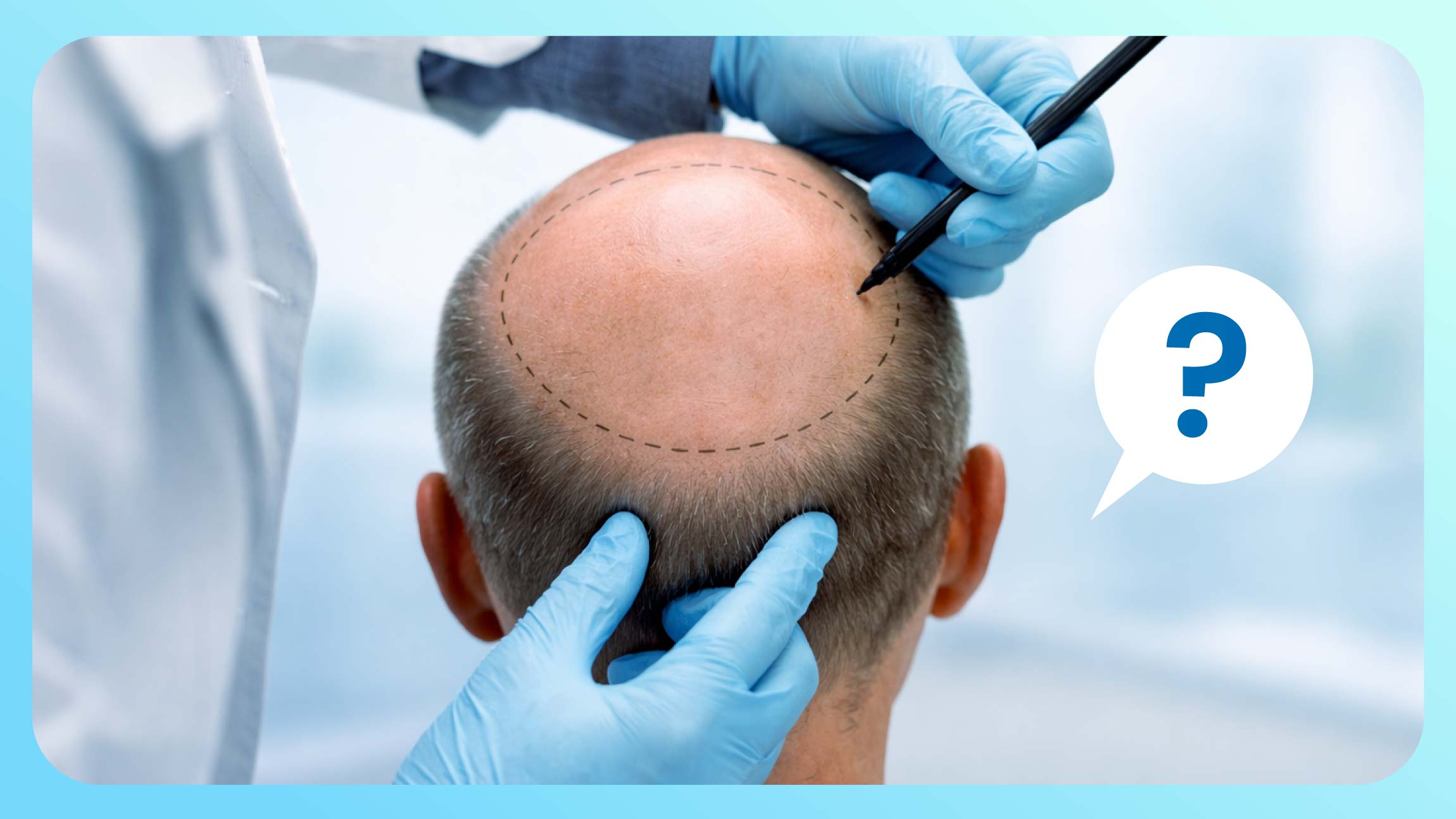 هل زراعة الشعر دائمة وهل لها أضرار؟ حقائق وأرقام