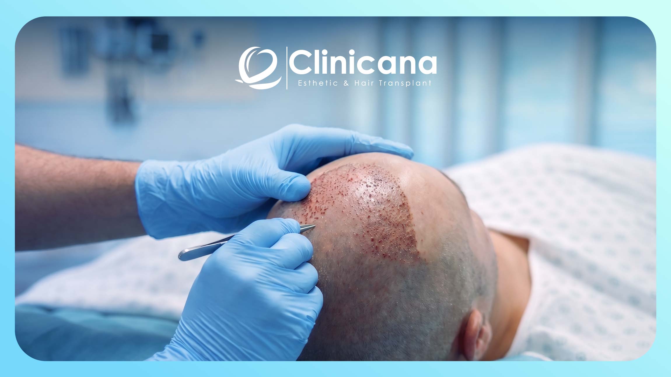 agencja turystyki medycznej przeszczep włosów