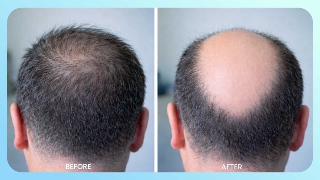 Genetic baldness and hair loss