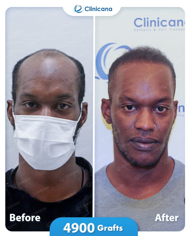 Previous transplant, or Afro-textured / curly hair