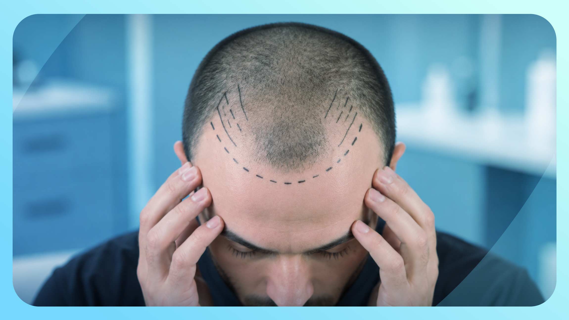 تورم الجبهة بعد زراعة الشعر: متى يكون طبيعياً ومتى يشير لمشكلة؟
