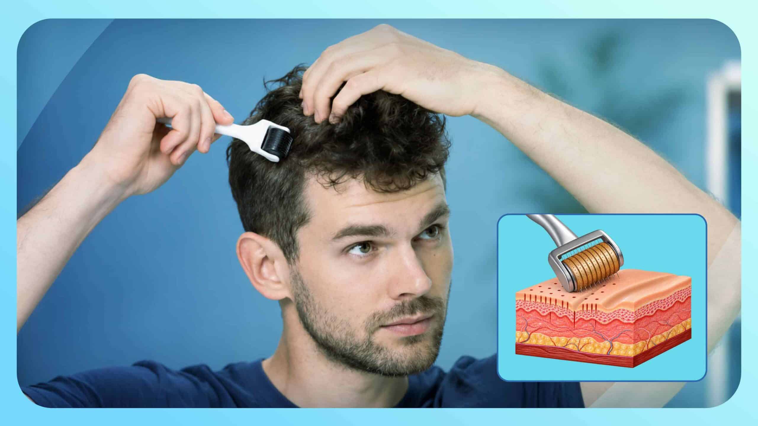 Derma Roller for Hair Growth: Medical Mechanism, Minoxidil Synergy, and Safety Guidelines