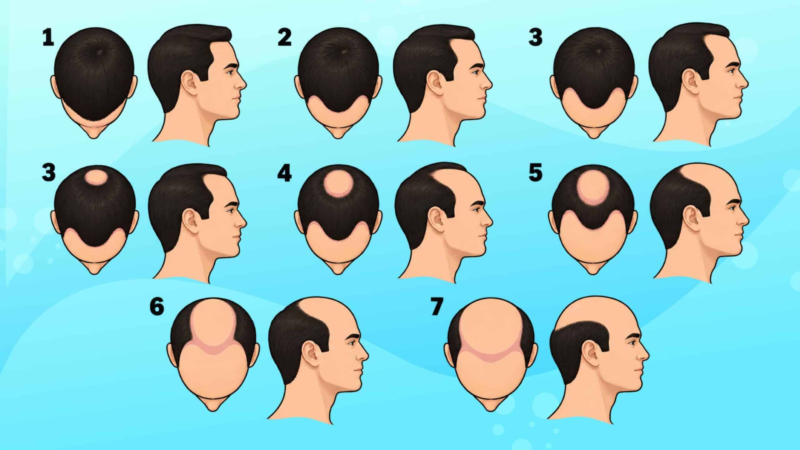 How to Check Your Norwood Scale Baldness Stage at Home: Self-Diagnosis & Prevention Guide