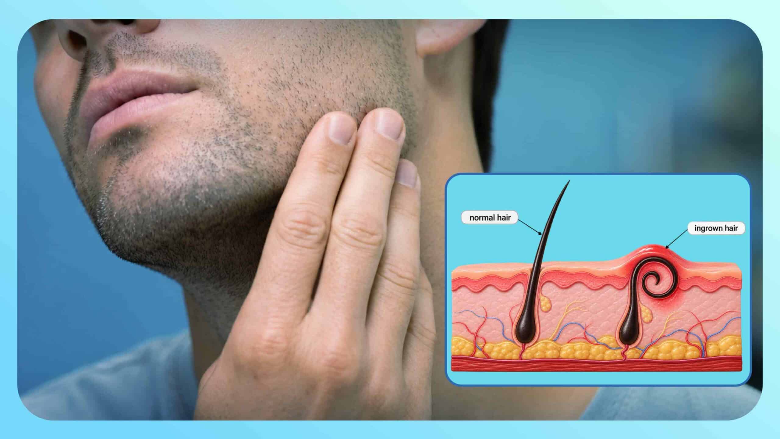 Ingrown Hair Treatment: What Actually Works (From a Surgeon Who's Seen the Damage)