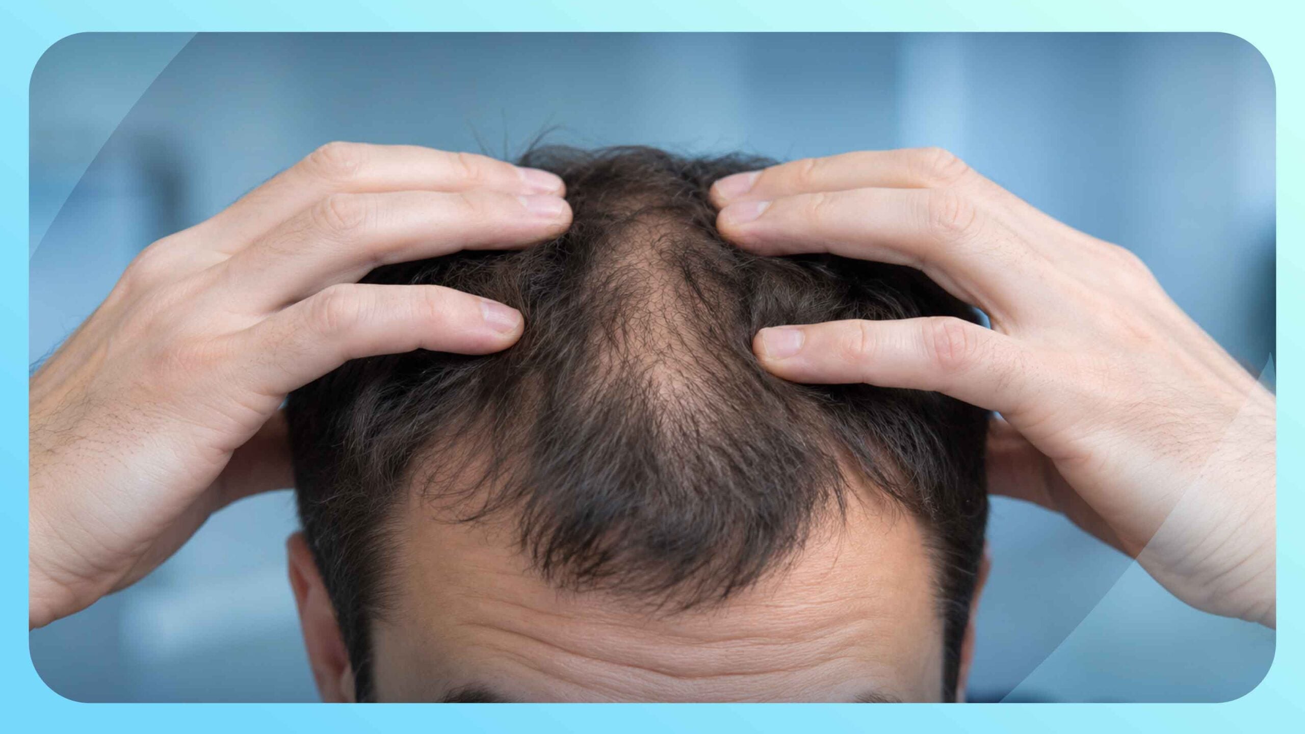 17-Alpha Estradiol (Alfatradiol) for Hair Loss: Efficacy, Mechanism, and Limitations