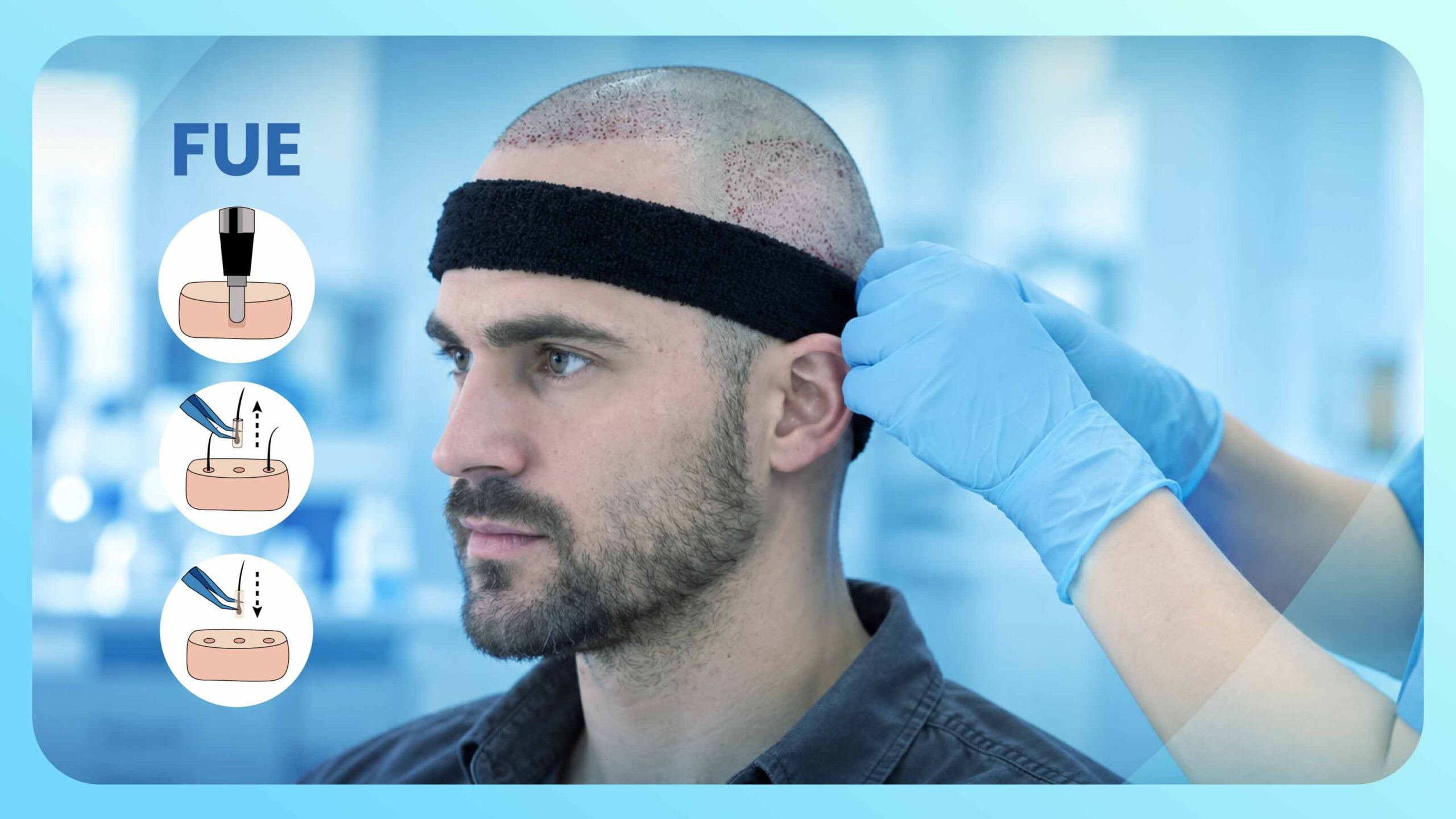 FUE Hair Transplant Side Effects and Recovery: What to Expect