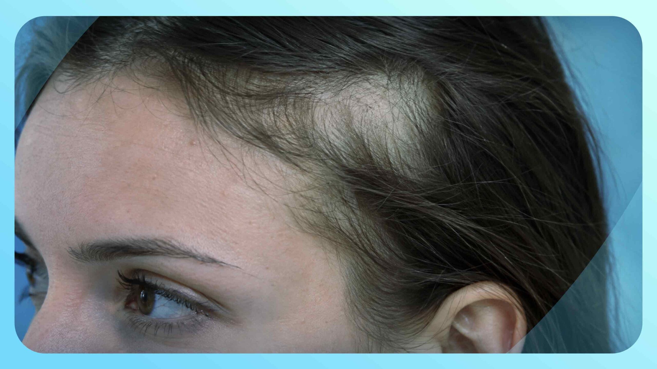Temporal Triangular Alopecia: Causes, Clinical Features, and Permanent Surgical Solutions