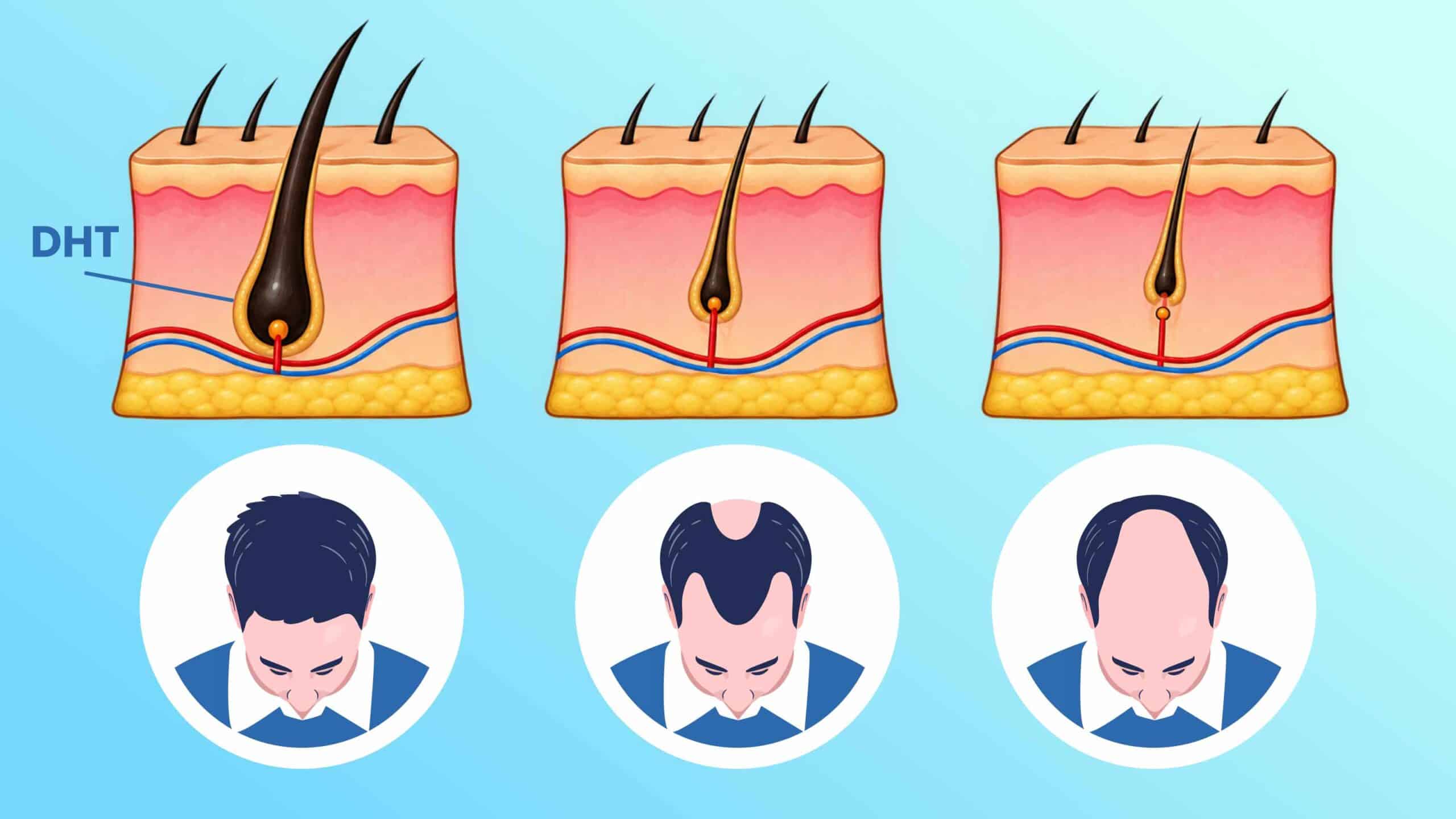 What Is DHT and How Does It Cause Hair Loss? Biological Mechanisms and Treatments