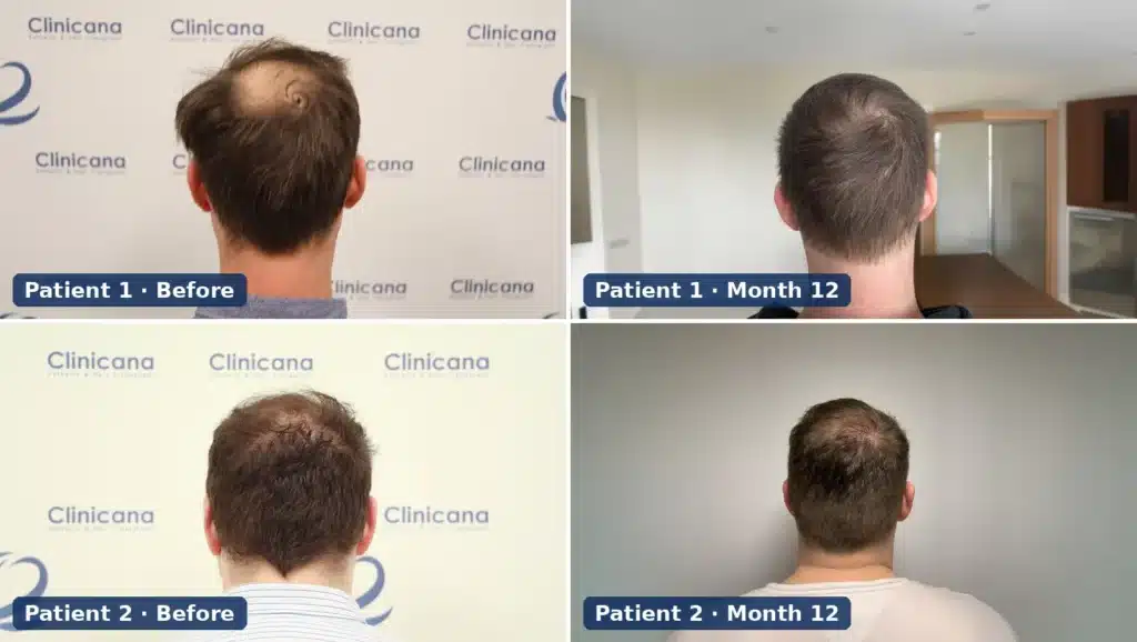 Two Clinicana crown hair transplant patients before surgery and 12 months after