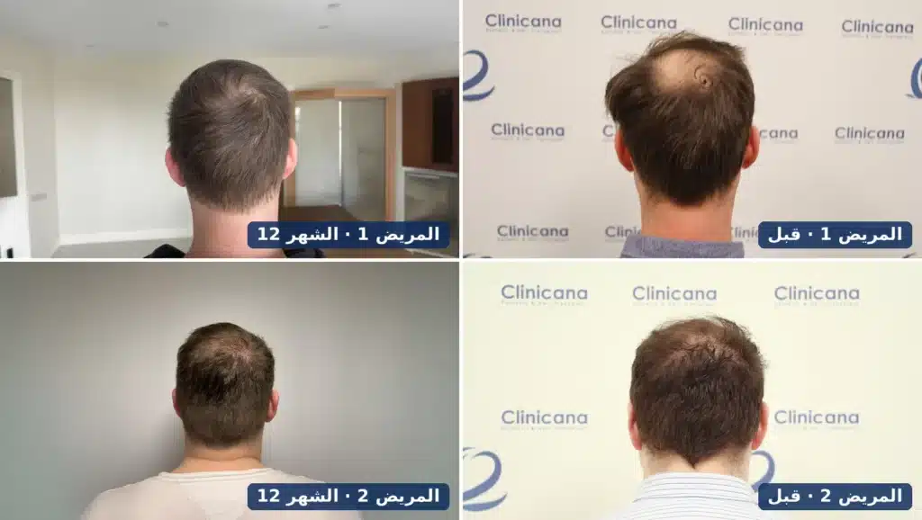 مريضان في كلينيكانا قبل زراعة شعر التاج وبعد 12 شهراً