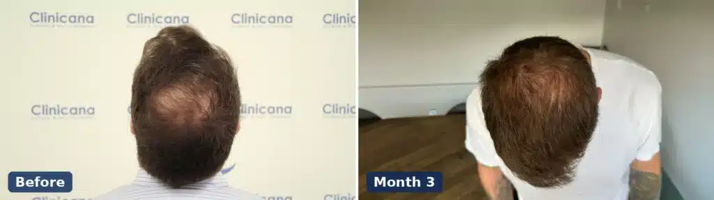 Crown before a hair transplant and the same crown 3 months after surgery