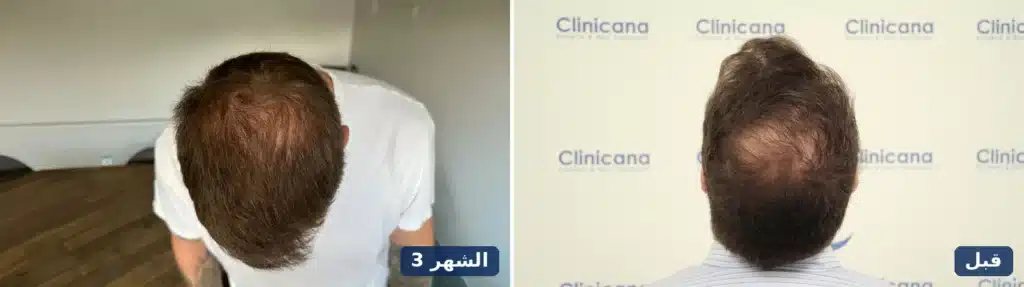 التاج قبل زراعة الشعر والتاج نفسه بعد 3 أشهر من العملية