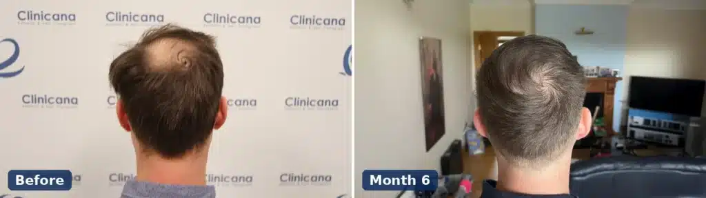Crown hair transplant before surgery and at 6 months, viewed from behind