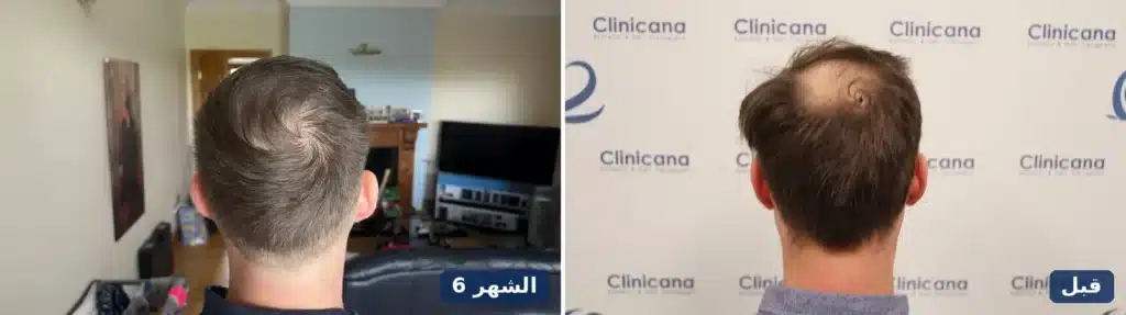 زراعة شعر التاج قبل العملية وبعد 6 أشهر من الخلف