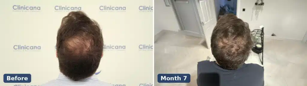 Crown hair transplant before surgery and 7 months after, viewed from above
