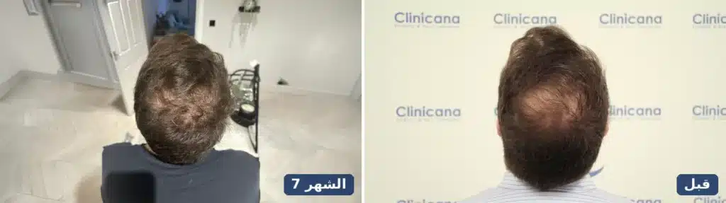 زراعة شعر التاج قبل العملية وبعد 7 أشهر من الأعلى