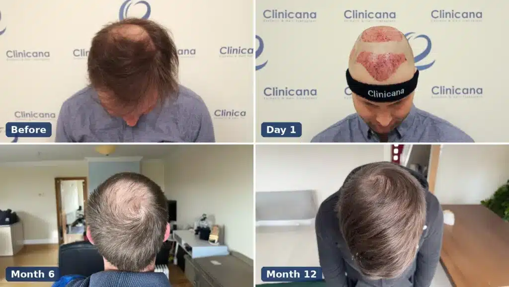 Crown hair transplant at Clinicana: the same patient before surgery, on day 1, at month 6 and at month 12, photographed from above