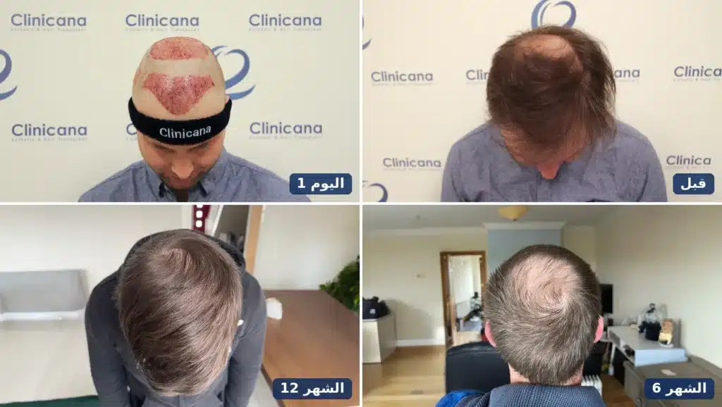 زراعة شعر التاج في كلينيكانا: المريض نفسه قبل العملية وفي اليوم الأول والشهر السادس والشهر الثاني عشر من الأعلى
