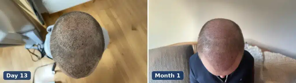 Crown hair transplant on day 13 with scabs gone and at month 1 during the shedding phase