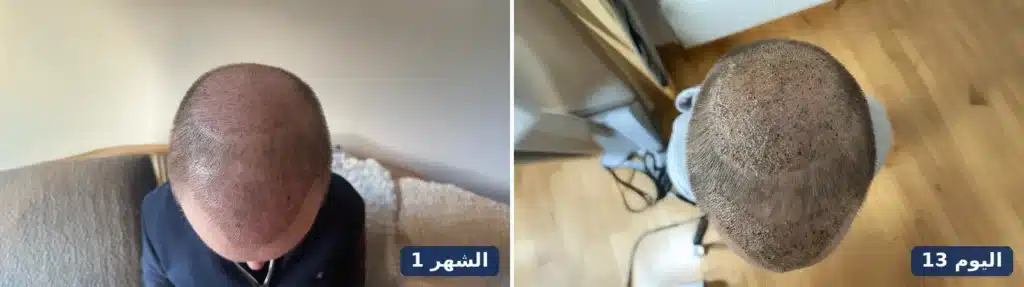 التاج في اليوم 13 بعد زوال القشور وفي الشهر الأول خلال مرحلة التساقط المؤقت