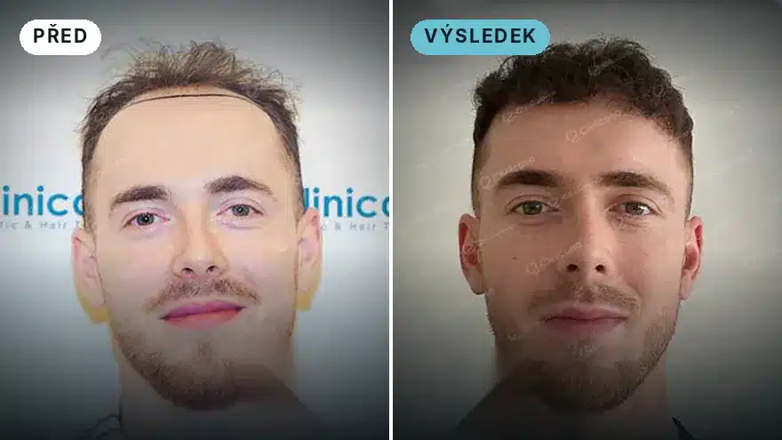Daniel ze Slovenska · 4 000 štěpů