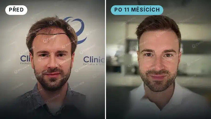 Karel · 3 700 štěpů · po 11 měsících