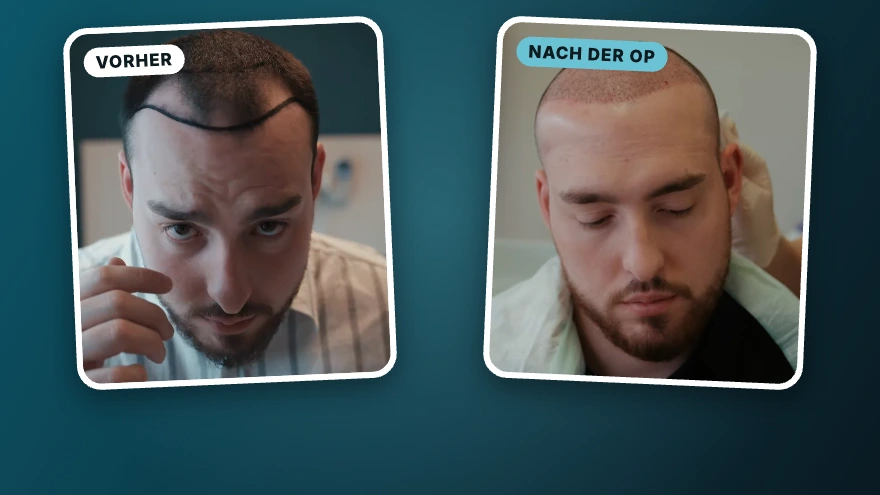 Evgenij · 3.300 Grafts