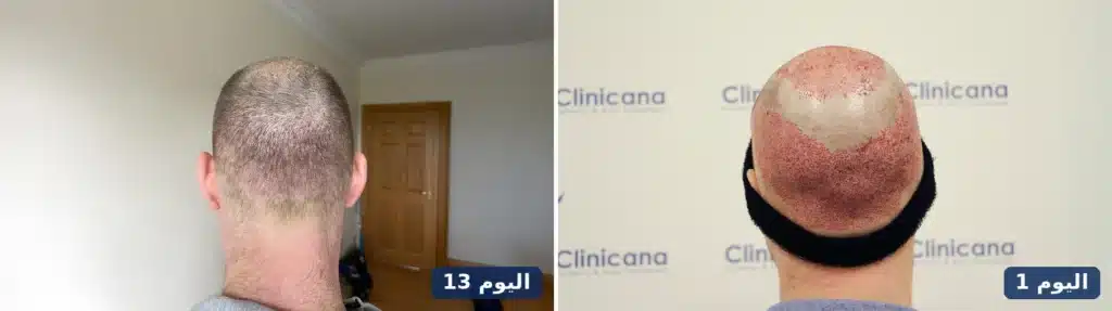المنطقة المانحة في مؤخرة الرأس في اليوم 1 واليوم 13 بعد زراعة الشعر