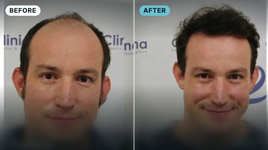 Andrew · USA · 4,500 grafts