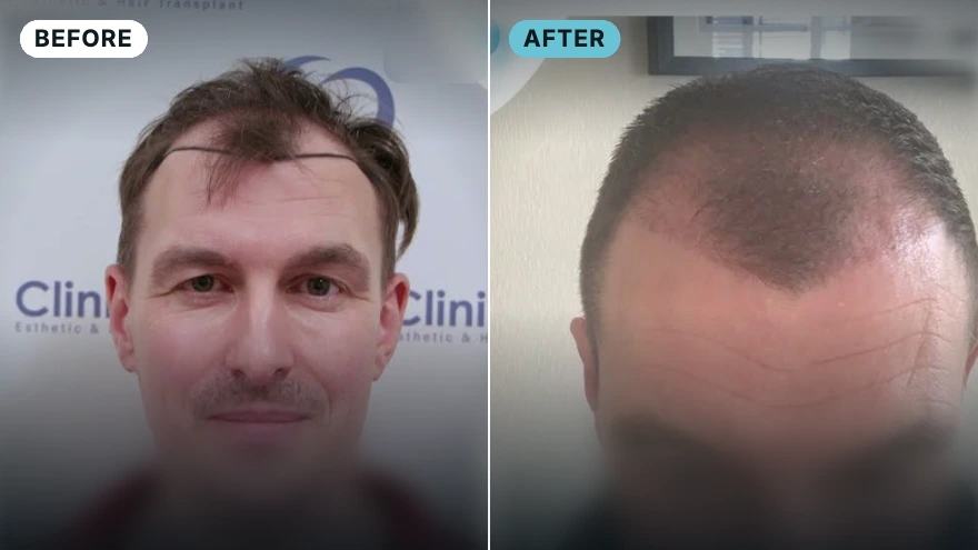 Daniel · 4,000 grafts · 12 months