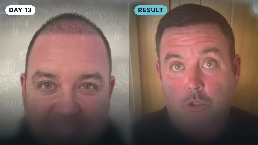 Graeme · 3,600 grafts · 12 months