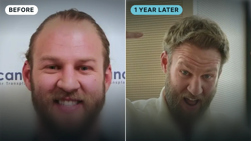 Back after 1 year · 3,800 grafts